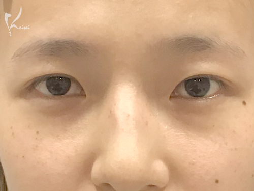 二重埋没法(MT埋没法3点留め)+目頭切開術(術後1ヶ月)