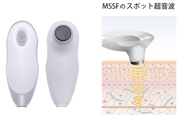 ベレーザプロ（ベビーハイフ）のMSSFハンドピース照射範囲