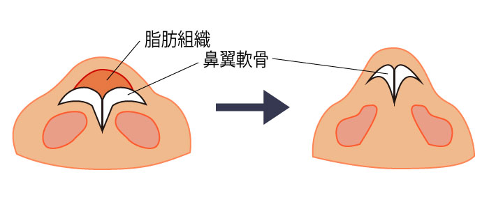 鼻尖形成 だんご鼻 鼻先 隆鼻 鼻尖縮小 大阪 鼻翼