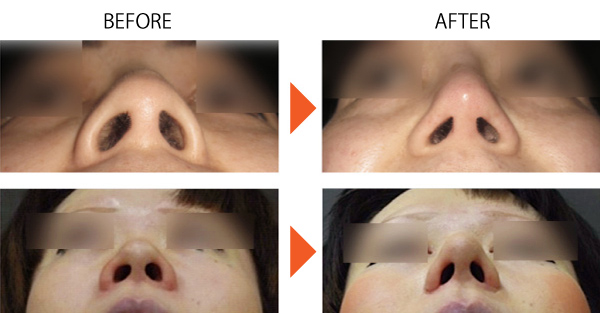 鼻尖形成 だんご鼻 鼻先 隆鼻 鼻尖縮小 大阪 症例