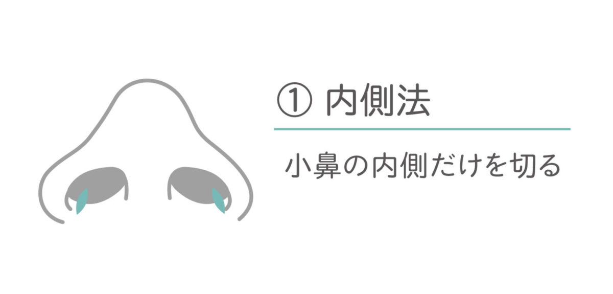 小鼻（鼻翼）縮小術 内側法 小鼻の内側だけを切る