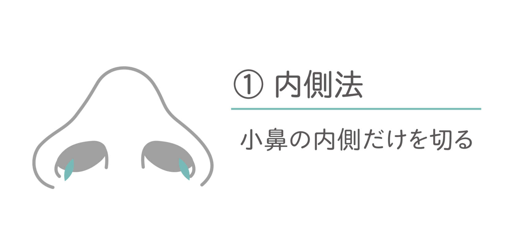 小鼻(鼻翼)縮小術 内側法 小鼻の内側だけを切る