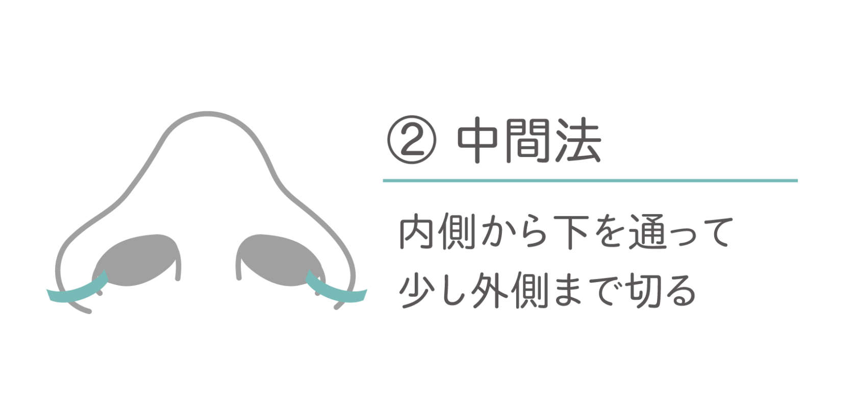 小鼻(鼻翼)縮小術 中間法