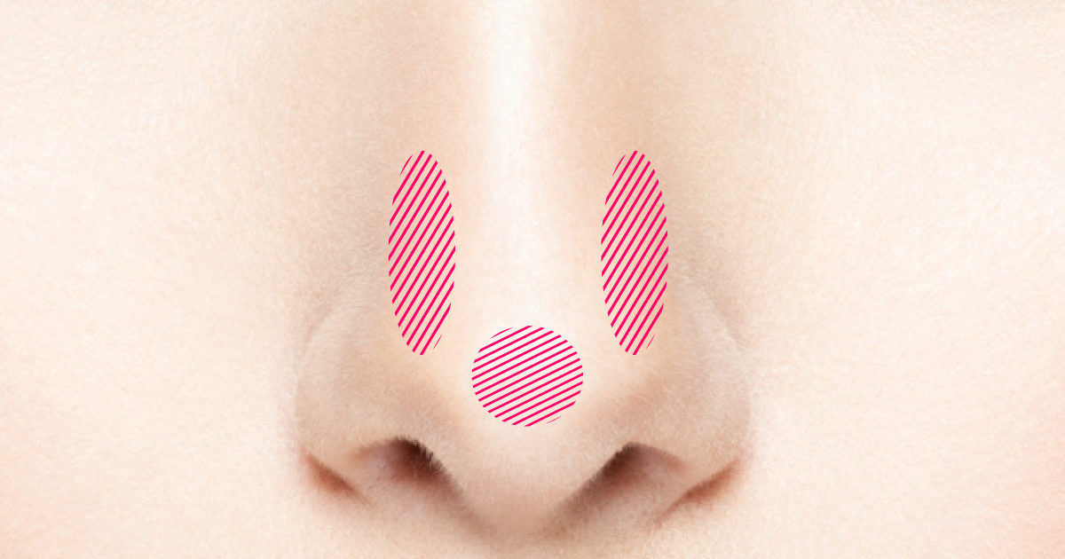 Bnlsによる鼻筋 小鼻 鼻尖縮小 Bnls 鼻の脂肪溶解注射 恵聖会クリニック 大阪の美容外科 美容皮膚科
