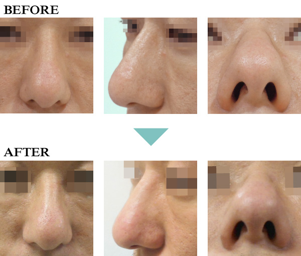 BNLSネオの鼻への注入の症例写真