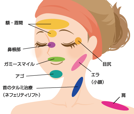 ボトックス 注入箇所 眉間 アゴ エラ ワキ 肩 目尻 ガミースマイル 鼻根部 首