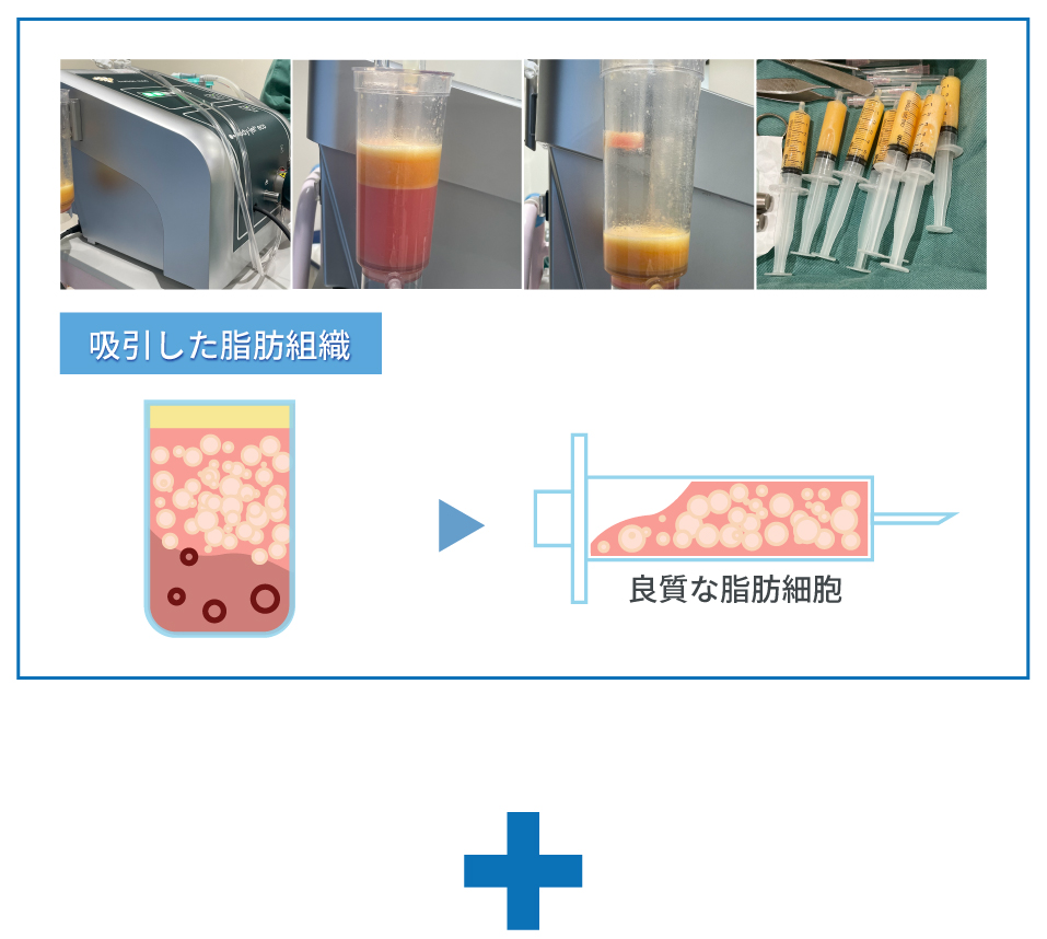 リポコレクター を用いた良質な脂肪細胞抽出