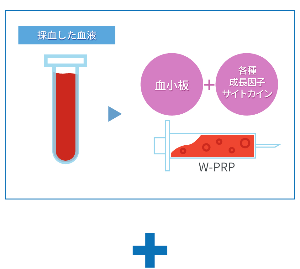 ご自身の血液より PRP （自己多血小板血）を抽出