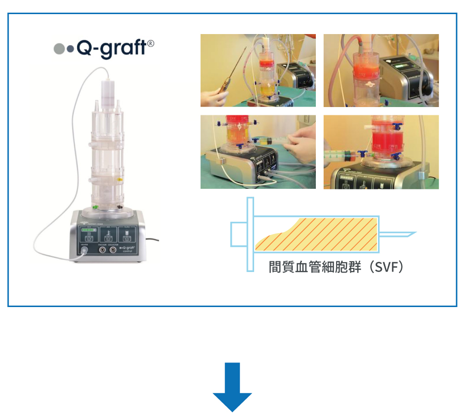 Q-graft （キューグラフト）を用いて間質血管細胞群（ SVF ）を抽出