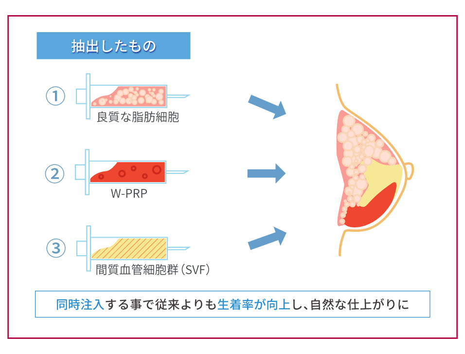 バストへ同時注入（良質な脂肪細胞、WPRP、間質血管細胞群（SVF）