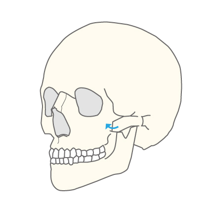 複合型頬骨形成術