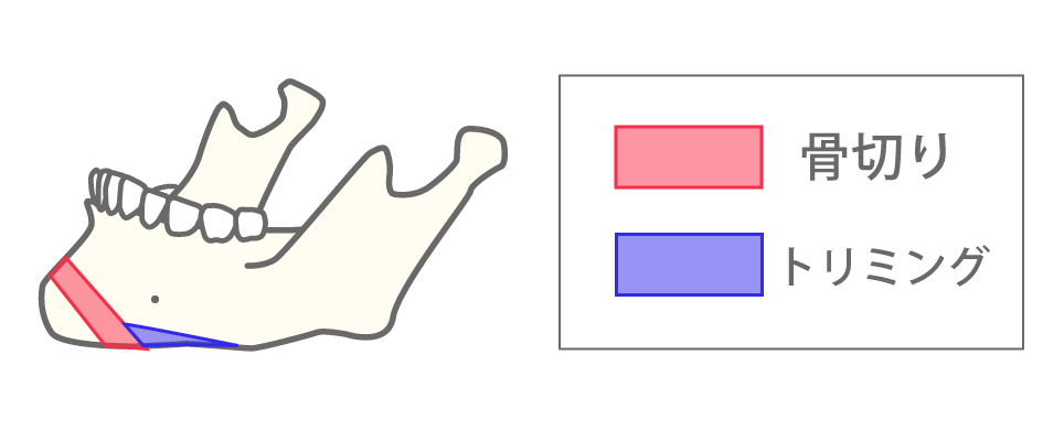 中抜き法（顎短縮、顎前進、顎後退）