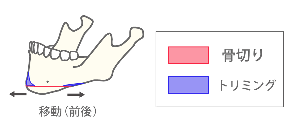 水平骨切り（顎前進、顎後退）