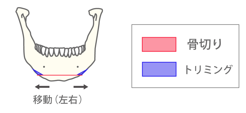 水平骨切り（左右移動）