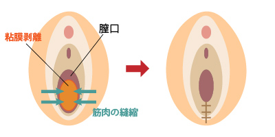膣縮小術