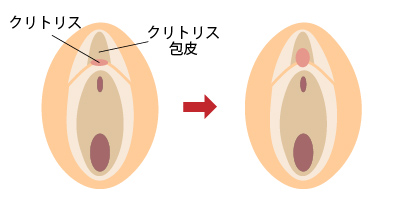 クリトリス 包茎 女性器形成 大阪 女性特有の悩み