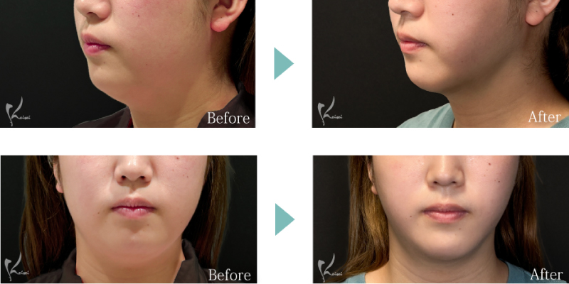 Before After