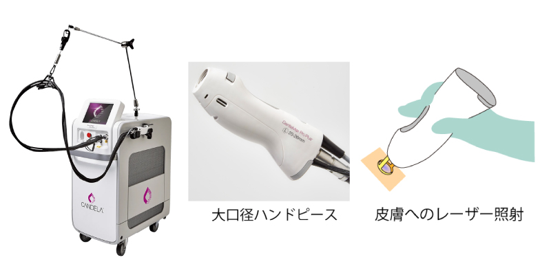 医療レーザー脱毛のイメージ