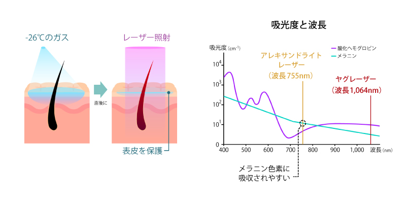 医療レーザー脱毛の原理