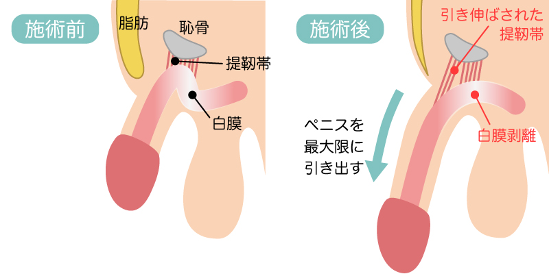 長茎手術イメージ