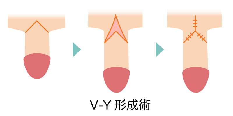 V-Y形成術