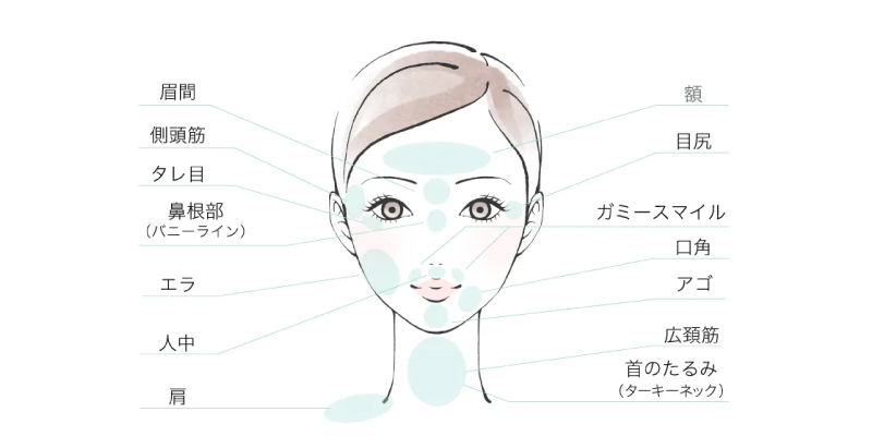 ボトックスで対応できる顔の部位
