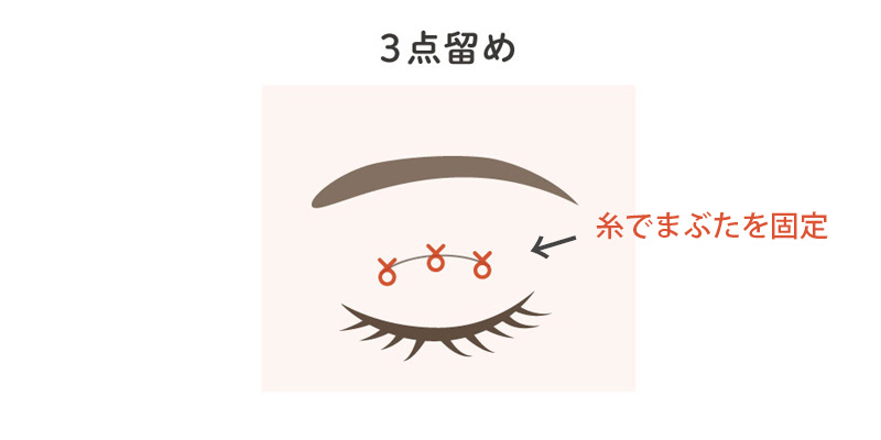 埋没法で二重ラインを形成するまぶたのイメージ