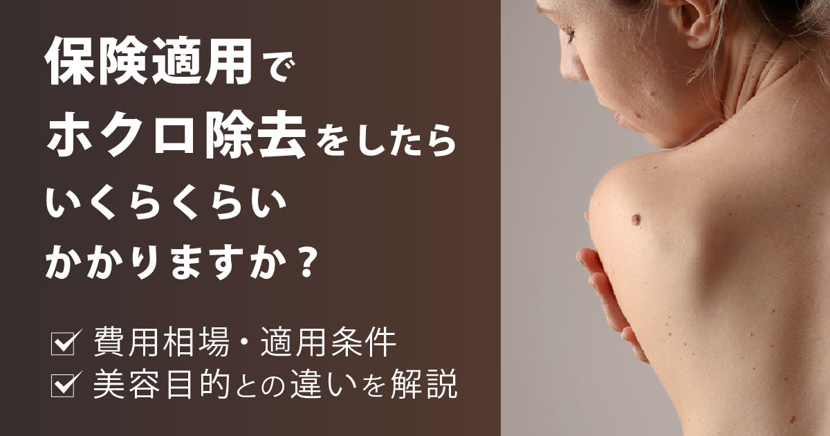 保険適用でホクロ除去をする場合の費用相場を解説するイメージ