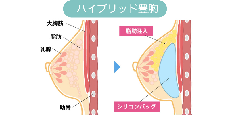 ハイブリッド豊胸