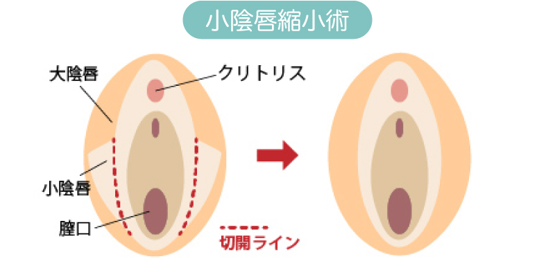 小陰唇縮小手術イメージ