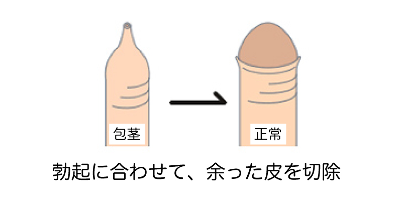 包茎手術イメージ