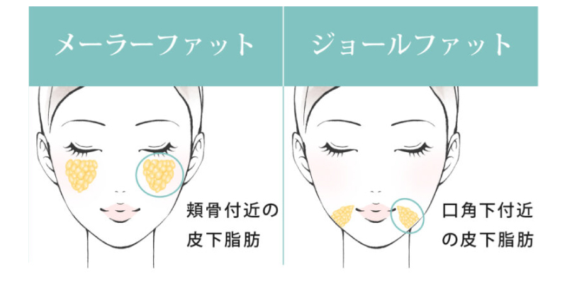 顔の脂肪吸引でフェイスラインの変化が出やすい人を説明するイメージ