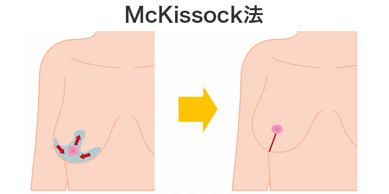 McKissock（マッキソック）法の施術イメージ