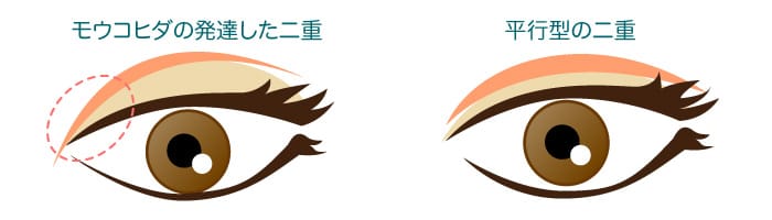 蒙古ひだと平行型二重の関係を説明するイメージ