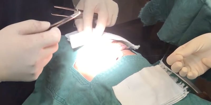 埋没法で二重ラインが薄くなる状態を説明するイメージ