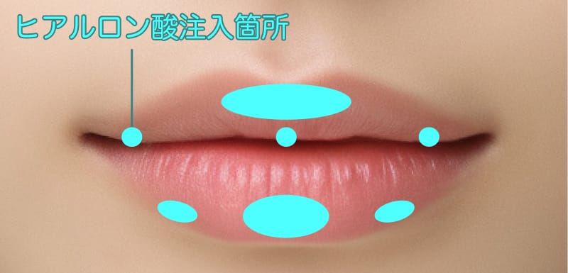 唇フィラーの注入部位による印象の違いを説明するイメージ