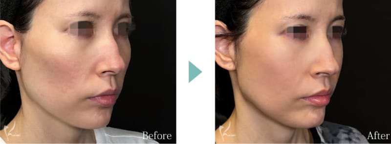 頬骨切りのBEFOREとAFTER