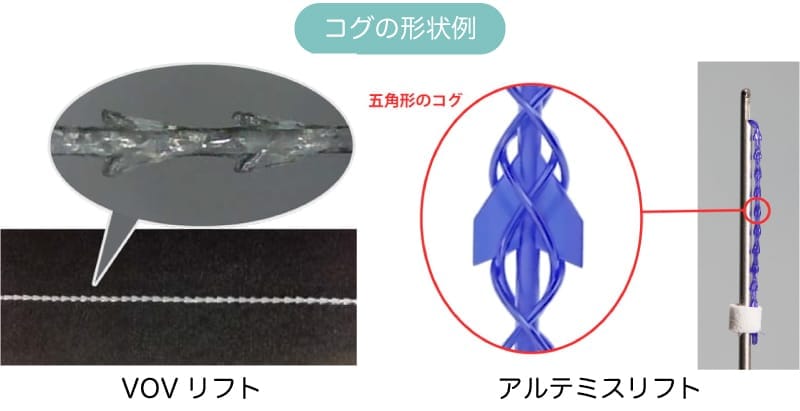 糸リフトで使用されているコグのイメージ