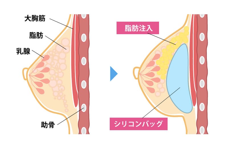 シリコンバッグ豊胸の施術方法を確認するイメージ