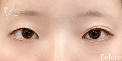 Before写真