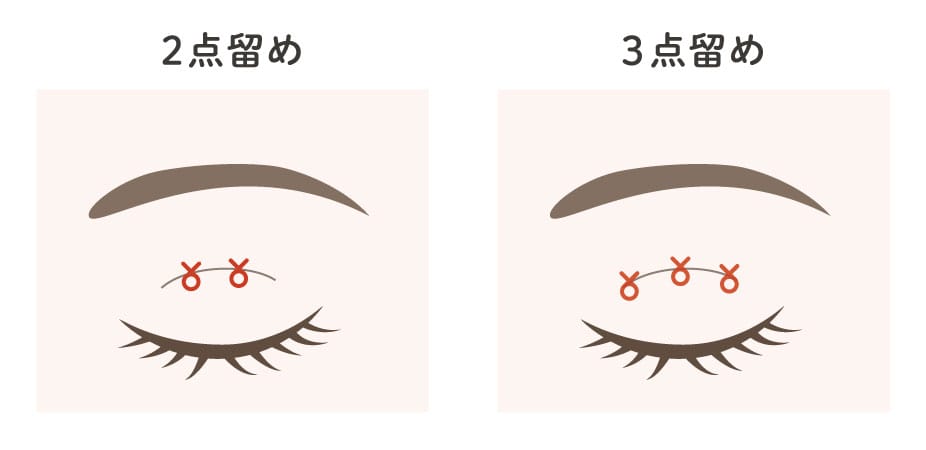 埋没法の2点留めと3点留めのイメージ