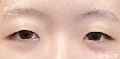 Before写真