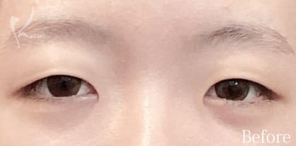 Before写真