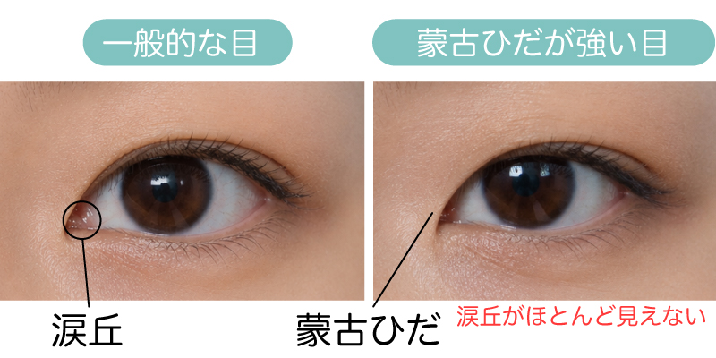 蒙古ひだ