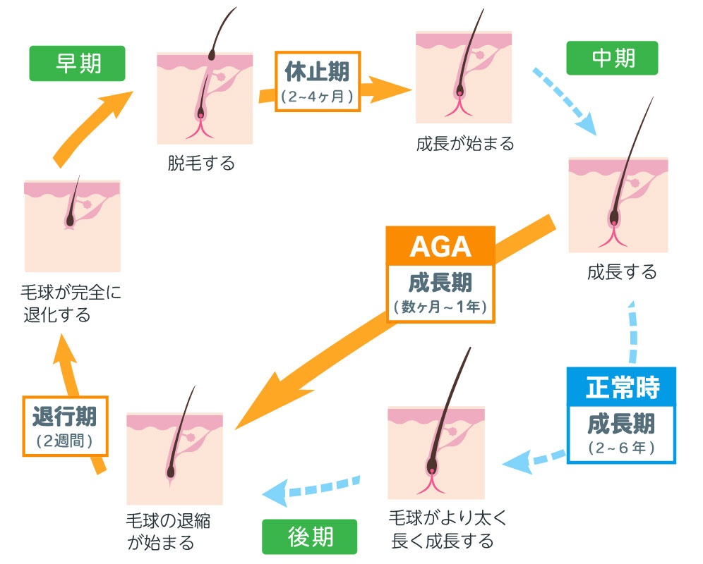 男性の生え際や頭頂部に現れるAGAのイメージ