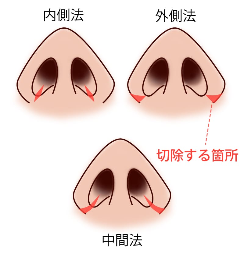 小鼻縮小の術式