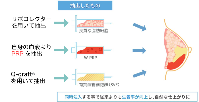 バストへ同時注入