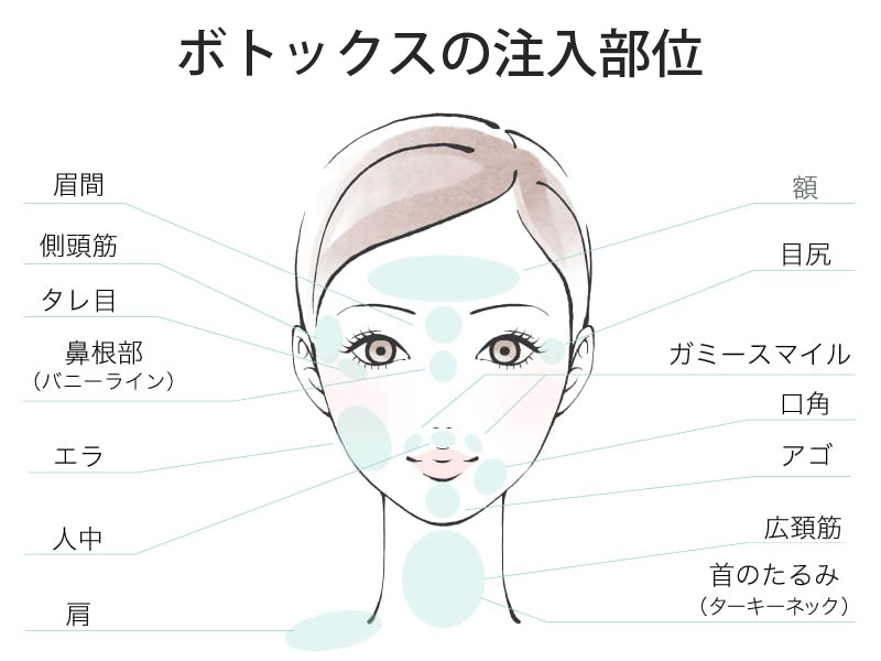恵聖会クリニックでのボトックス注入部位