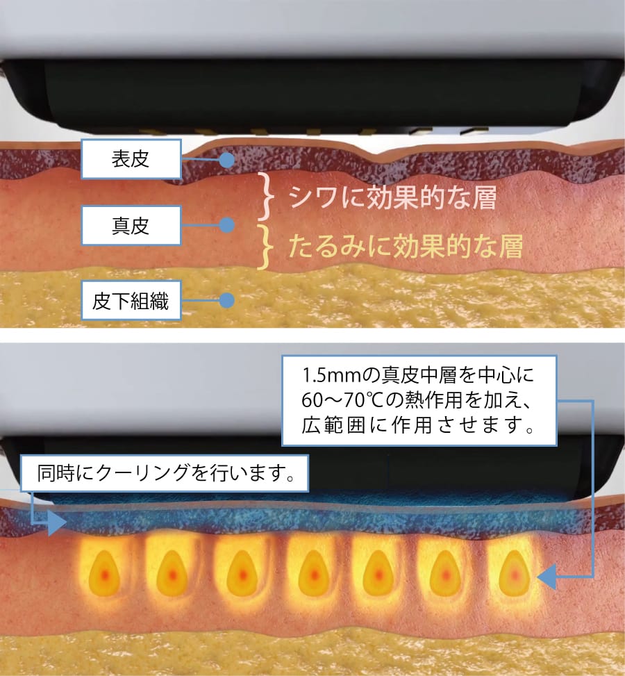 ソフウェーブのSUPERB™が作用するイメージ