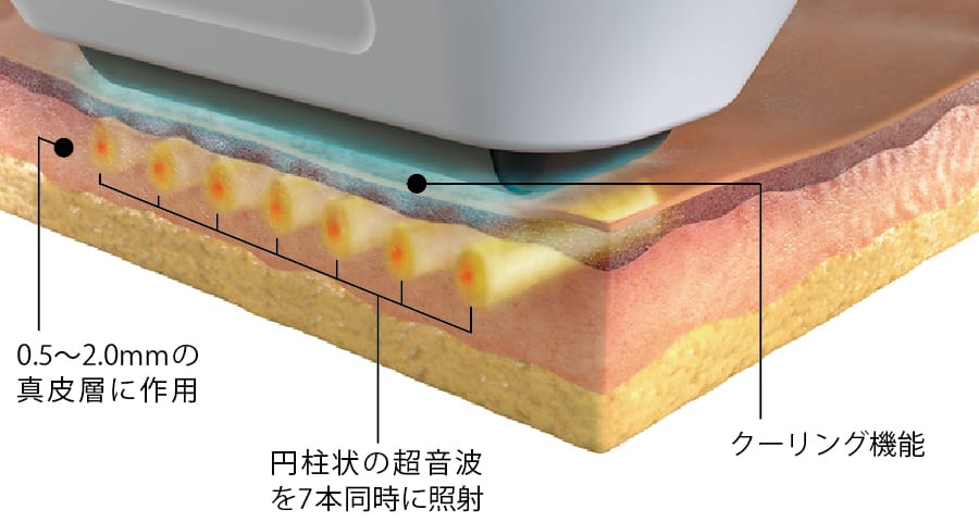 ソフウェーブが真皮へ超音波を照射する仕組み